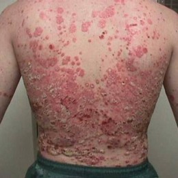 psoriasis